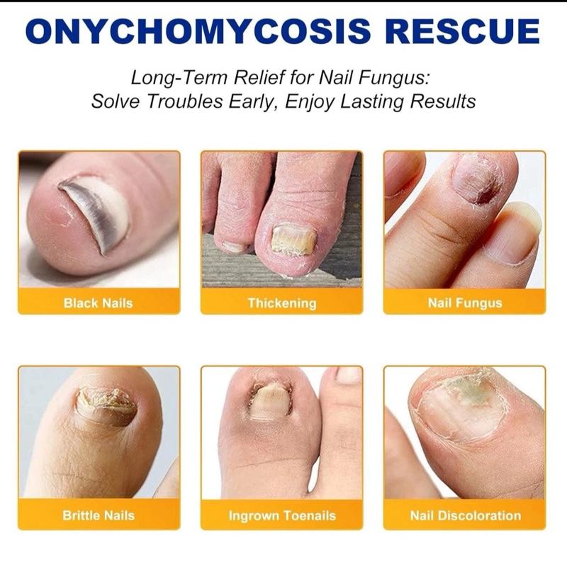 Fungal Nail Patches - 3 Pack 8-Hour Overnight Repair for Damaged & Discolored Nails - 32 Patches for Healthier Nails - Easy Application & Hygienic Design