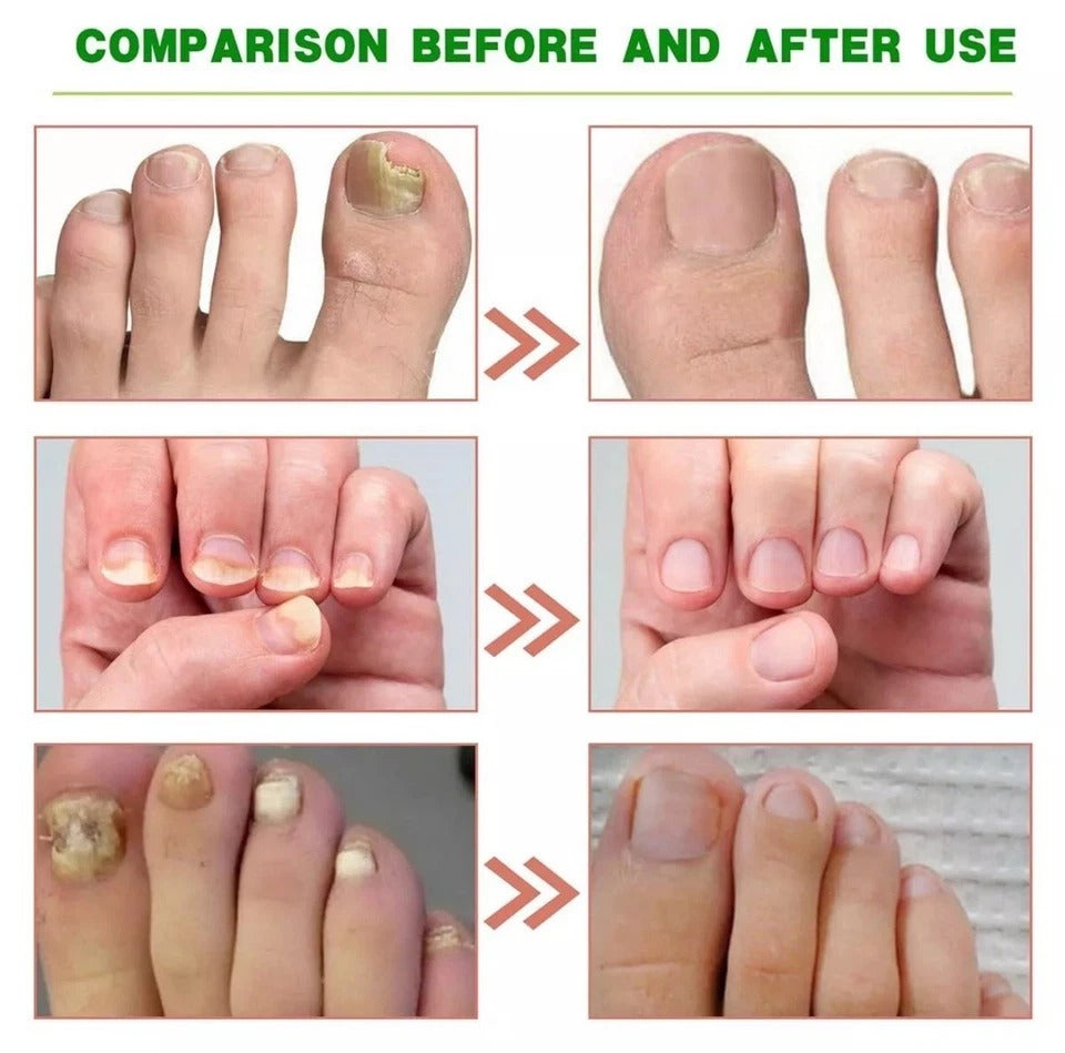 3-Pack 7-Day Toenail Fungus Repair – Extra Strength for Discolored Nails