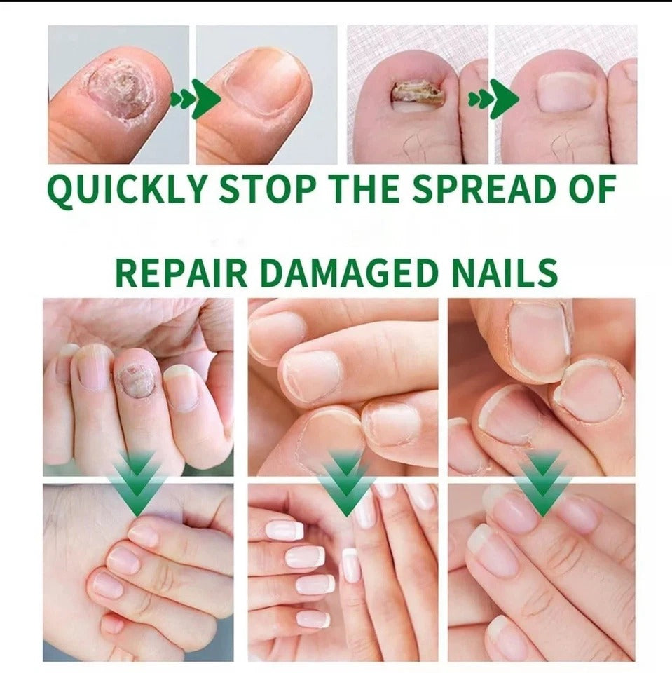 3-Pack 7-Day Toenail Fungus Repair – Extra Strength for Discolored Nails