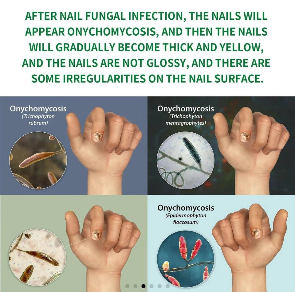 7-Day Toenail Fungus Treatment (2 Pack) Extra Repair for Discolored Nails 30MLx2