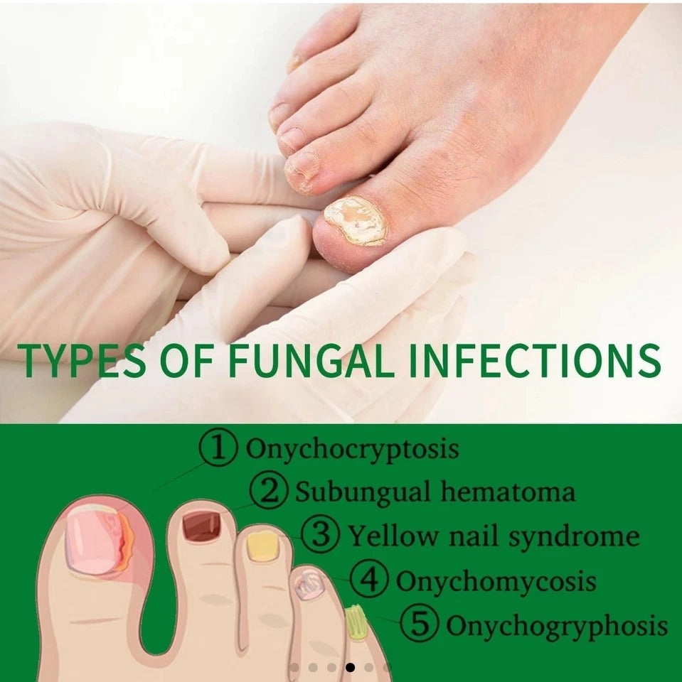 7-Day Toenail Fungus Treatment (2 Pack) Extra Repair for Discolored Nails 30MLx2